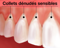 collets denudes sensibles