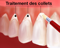 traitement des collets