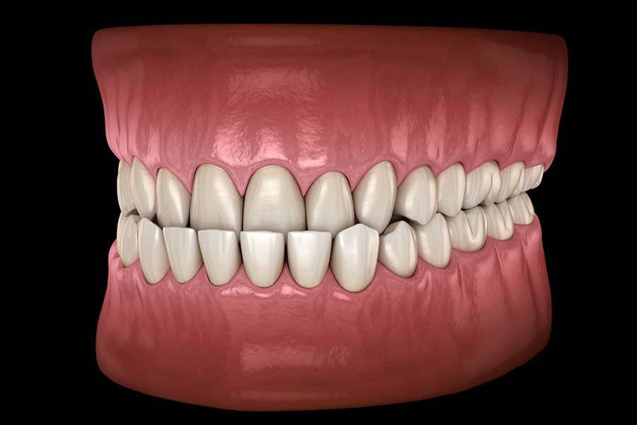 occlusion dentaire inverse