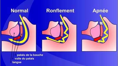 ronflement et apnee du sommeil