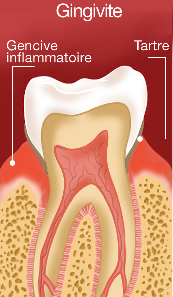 gingivite