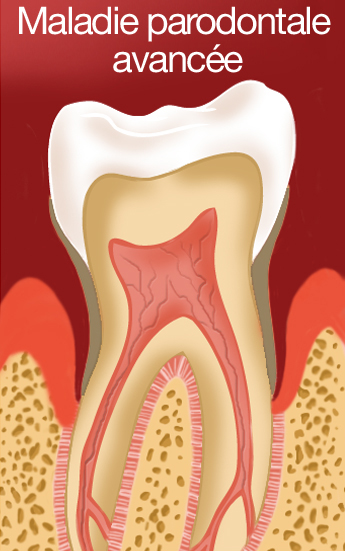 maladie parodontale avancee