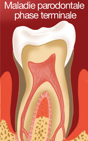 maladie parodontale phase terminale