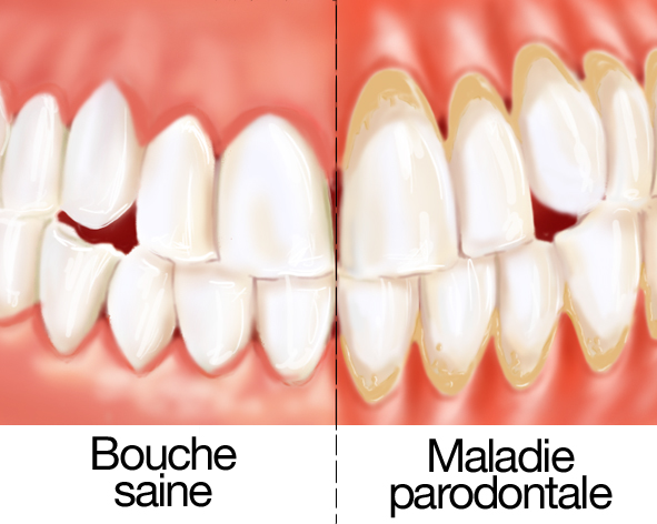 parodontite