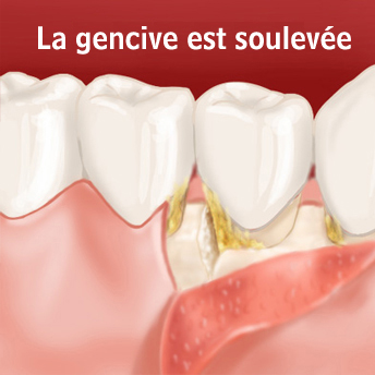 gencive soulevee