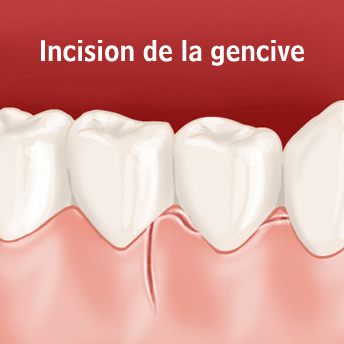 incision gencive