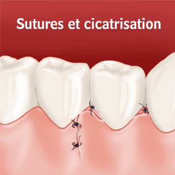 sutures cicatrisation