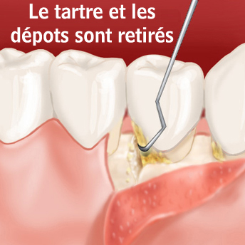 tartre depots retires