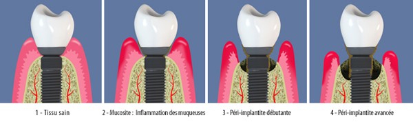 peri implantite