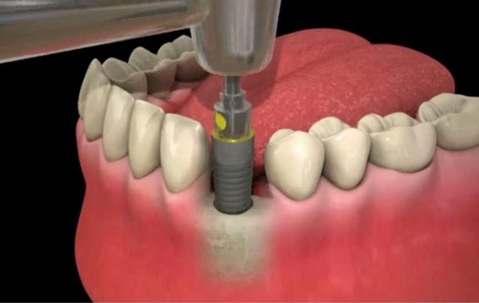 mise en place de l implant