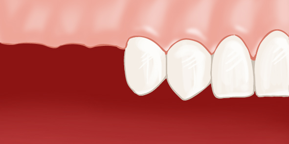 edentement lateral