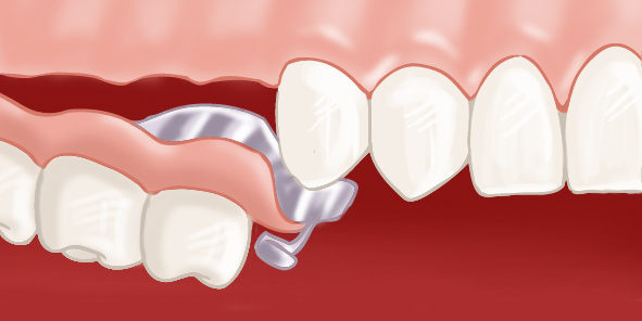 insertion prothese