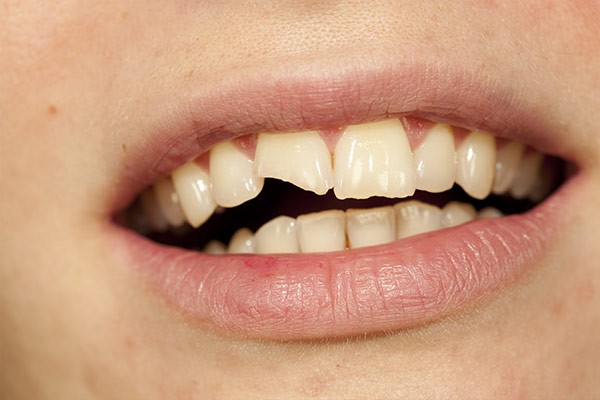 Dent cassée, dent accidentée