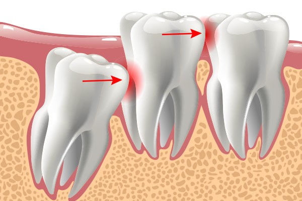 Les dents de sagesse