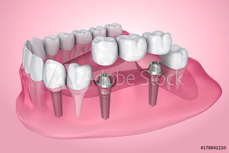 Qu'est-ce qu'un implant dentaire ? Indications et contre-indications